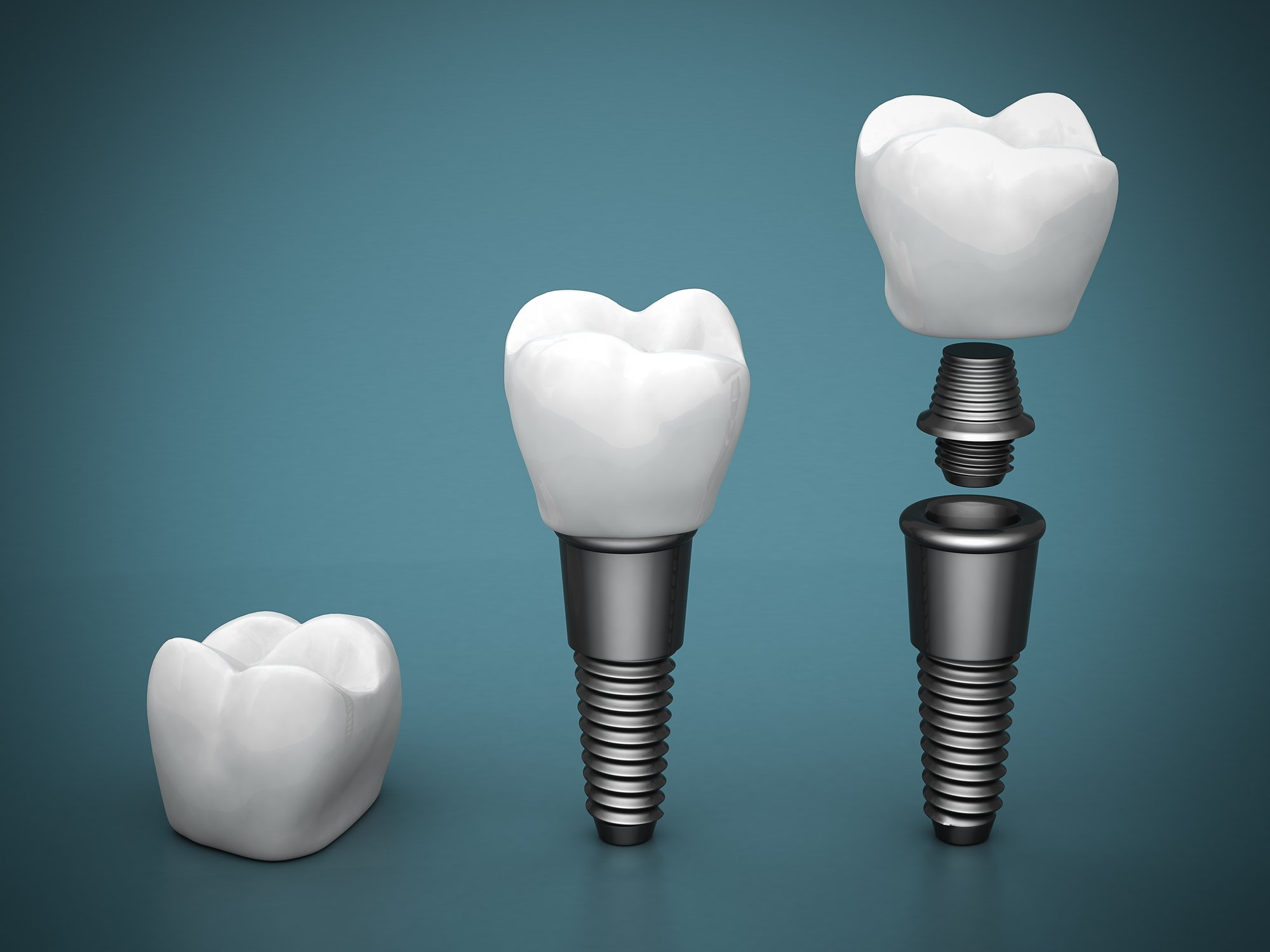 Chọn lựa nguồn gốc và chất lượng của trụ Implant cũng là yếu tố không thể bỏ qua khi quyết định điều trị