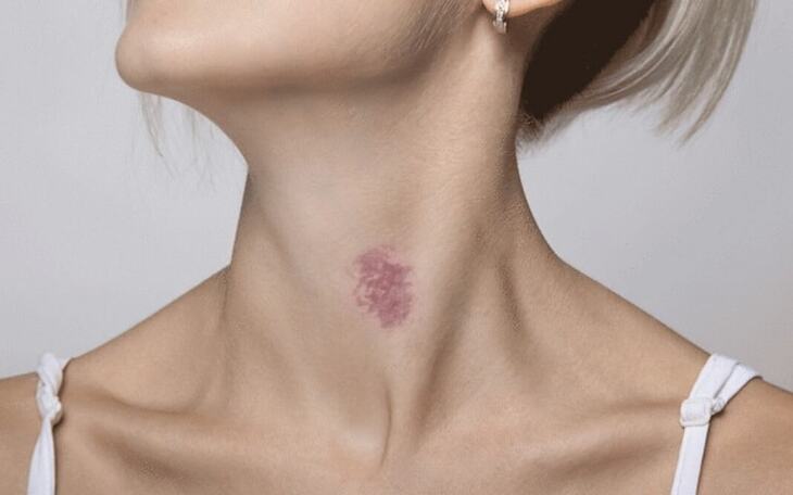 Hickey - Bạn Đã Biết Cách Đánh Dấu Đối Phương Bằng Nụ Hôn Táo Bạo?