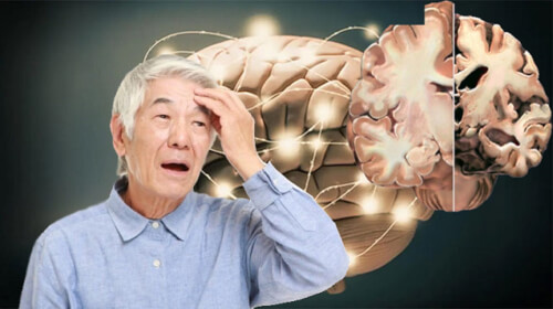 Bệnh Alzheimer là gì 4